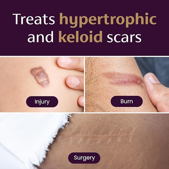 Mederma Medical Grade Silicone Scar Sheets; Improves The Appearance of Old and New Scars; for Injury, Burn and Surgery Scars, 4 Count